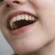 Troubles psychosomatiques liés à la bouche et aux dents